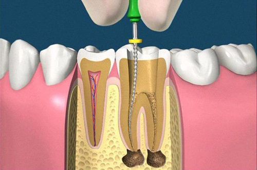 Root canal and alternative solutions