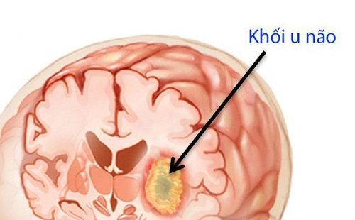 Khối u ở não là nguyên nhân gây tăng áp lực sọ não trong ung thư