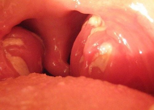 Symptoms and images of abscesses around the tonsils