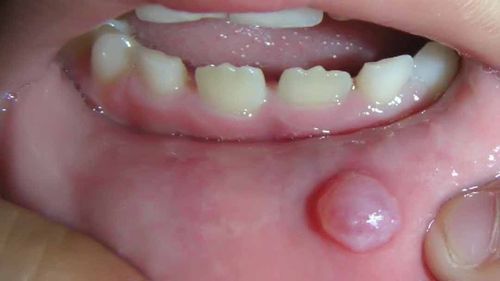 Mucus cyst on lips