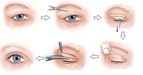 How long does it take to cut eyelids?