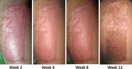Autologous skin grafts: Indications and implementation