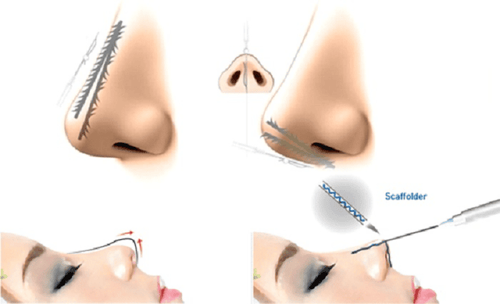 Should I lift my nose with thread or inject filler?