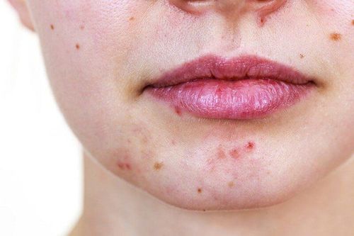 Causes of acne appear more around the mouth