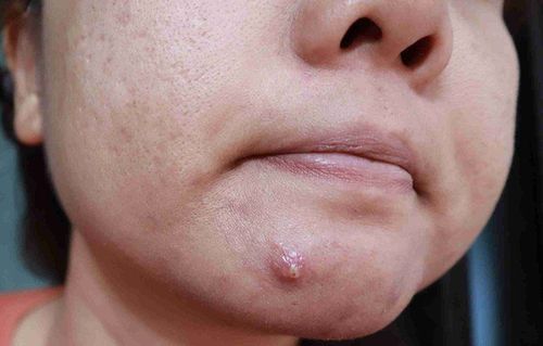 Should pus-filled pimples be squeezed?