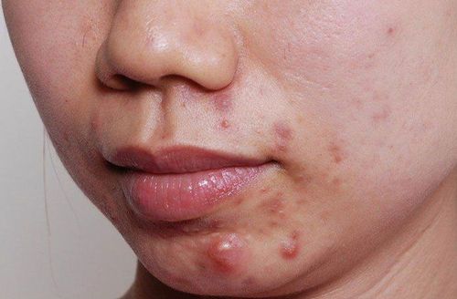 Should acne on the chin be squeezed?