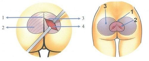 
Nâng mông nội soi là phương pháp nâng mông bằng túi độn kết hợp với kỹ thuật nội soi để tăng hiệu quả và an toàn
