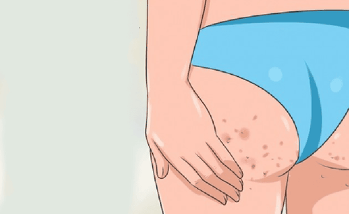 Pimples on the buttocks and what you need to know.