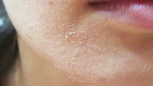 Causes of facial peeling