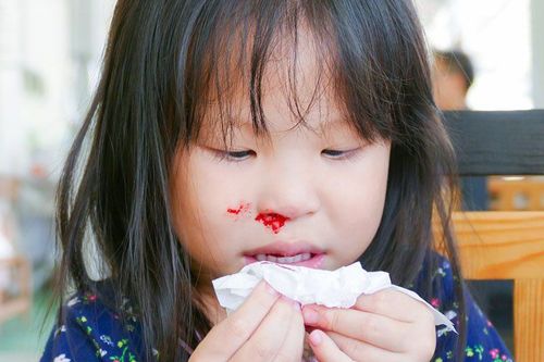 Nguyên nhân chảy máu mũi ở trẻ em