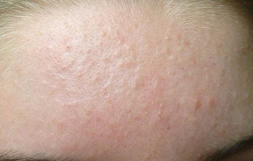 What is hidden acne? Signs to recognize hidden acne