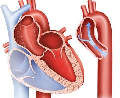 
Bóc tách động mạch chủ ngực gây cơn đau ngực nguy hiểm
