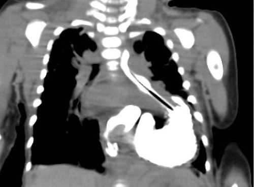 Nhão cơ hoành bẩm sinh trên hình ảnh MRI