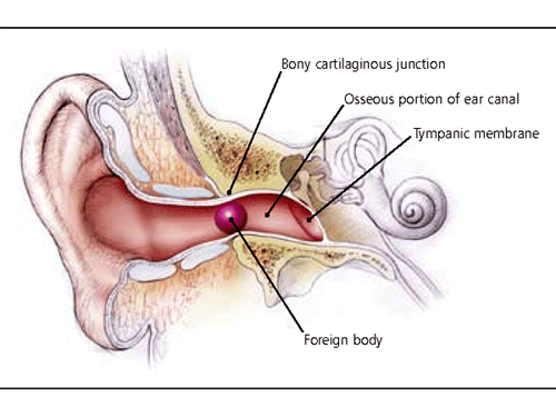 
Ear foreign body removal should be performed by a doctor as soon as possible
