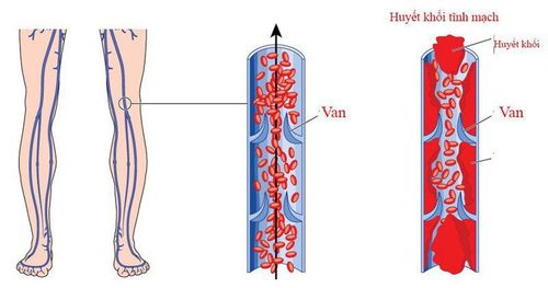 Prevention of venous thrombosis during and after surgery