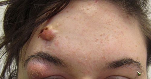 Acne on the forehead: Causes and treatment