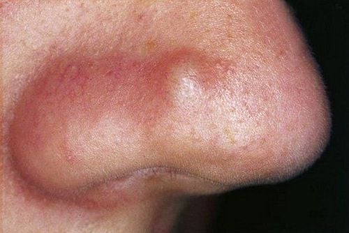 Nose acne: Causes and treatment