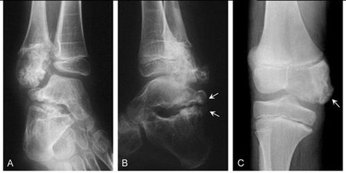 Bone lesions on X-ray images