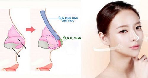 Có nên nâng mũi bọc sụn tự thân không