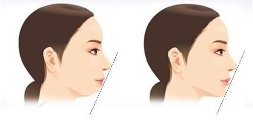 
Người có cằm lẹm có thể lựa chọn làm đẹp bằng tiêm filler cằm
