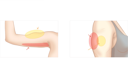 
Tiêm tan mỡ bắp tay giữ được bao lâu có thể phụ thuộc vào vùng tiêm và cơ địa
