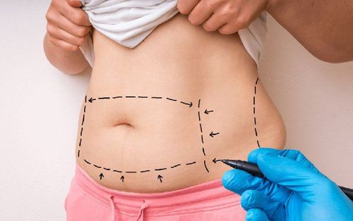 Postpartum tummy tuck surgery and what you need to know