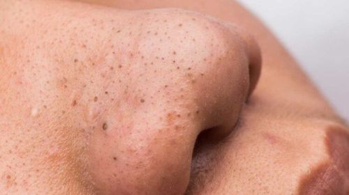 Blackheads should use AHA or BHA?