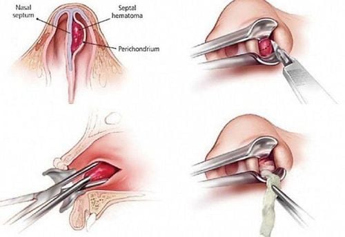 Indications for burning the nose: What you need to know