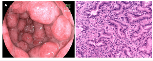 
Biểu hiện nội soi và vi thể của viêm loét đại tràng liên quan đến viêm dạ dày. A: Hình ảnh nội soi cho thấy nhiều tổn thương lồi dạng hình cầu của niêm mạc dạ dày; B: Hình ảnh hiển vi cho thấy niêm mạc bị viêm với những thay đổi dạng polypoid tăng sản.
