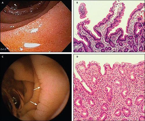 
Viêm tá tràng có sự trùng lặp với bệnh celiac
