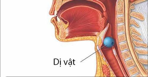 Pick up foreign body in throat