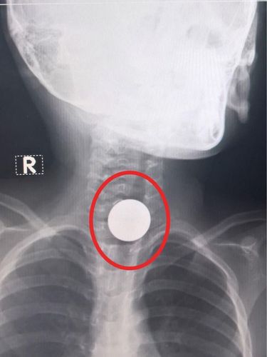 Abdominal removal of esophageal foreign body