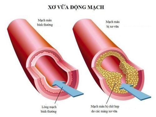 Virut viêm gan C cũng có thể gây ra xơ vữa động mạch