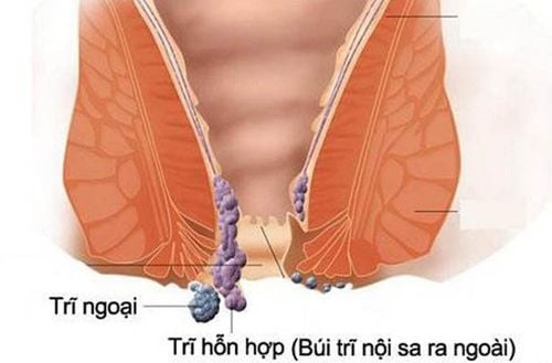 What to do with bowel disorders after mixed hemorrhoidectomy?