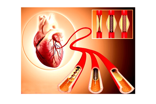 
Tắc mạch sau đặt stent là một biến chứng ít gặp nhưng nghiêm trọng
