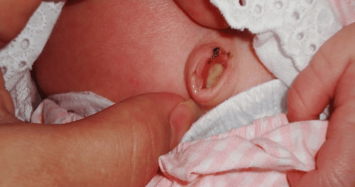 Trẻ sơ sinh bị viêm rốn có triệu chứng như thế nào?