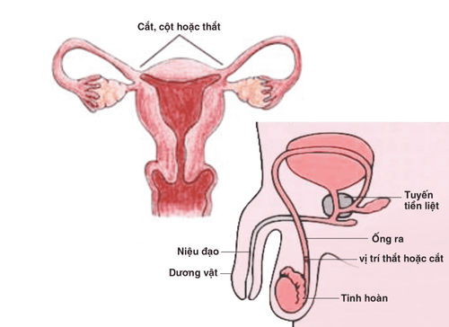 Các biện pháp ngừa thai vĩnh viễn