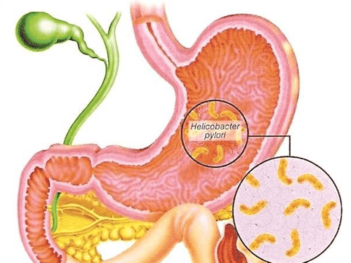 Tình trạng phát triển các bệnh lý tiêu hóa trong dân số nhiễm H.Pylori