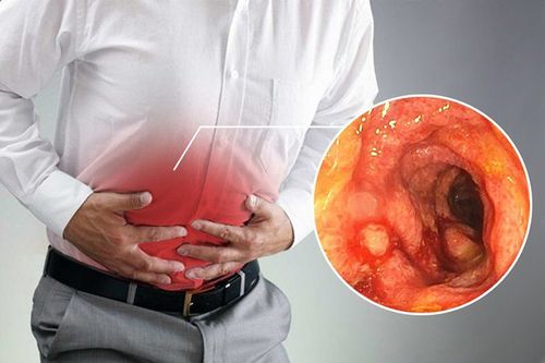 Why does ulcerative colitis affect the upper digestive tract?