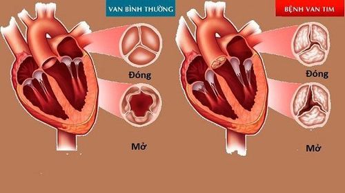 
Bệnh van tim cần được thăm khám và điều trị sớm
