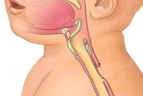 Esophageal atrophy: A common disease of gastrointestinal atrophy