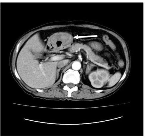 
Dự đoán phân tầng u mô đệm đường tiêu hóa qua ảnh CT
