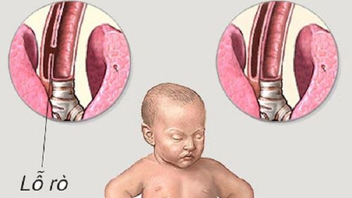 Surgery to close the esophageal fistula