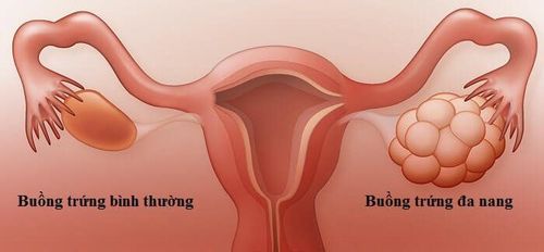 Mắc buồng trứng đa nang có thể mang thai tự nhiên không?