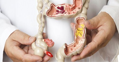 Everything you should know about rectal prolapse