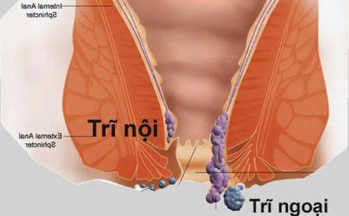 Hậu môn có cục thịt lòi ra kèm theo cục máu đông có phải bị trĩ nội không?