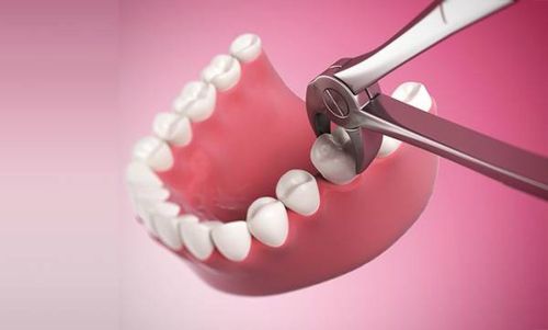 Nguyên nhân và cách điều trị đau đầu sau nhổ răng số 7 hàm dưới là gì?
