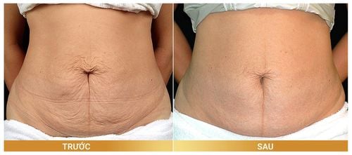 Treatment of sagging abdominal skin after weight loss without surgery