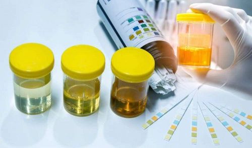 Urine crystals: Causes and classifications