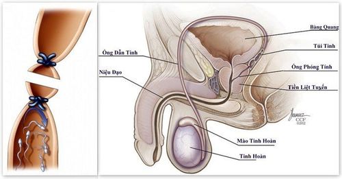 
Phương pháp thắt ống dẫn tinh có thể áp dụng trong hầu hết các trường hợp nam giới có mong muốn tránh thai vĩnh viễn
